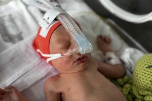 Noworodek z rurką oddechową.