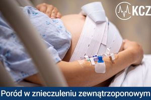 Poród w znieczuleniu zewnątrzoponowym.